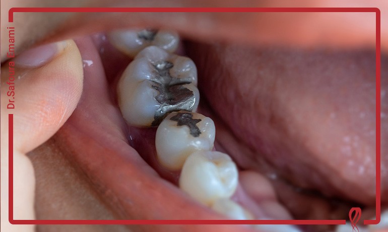 پرکردن دندان چند سال دوام دارد؟ چطور بیشتر عمر کند؟